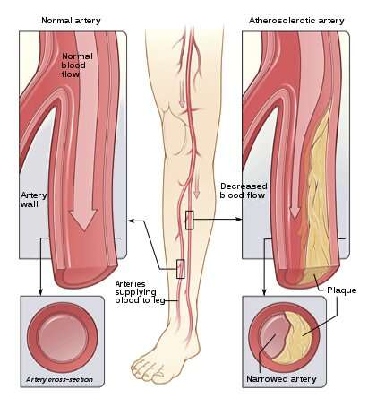 Peripheral artery disease is poorly understood, but researchers are striving for answers