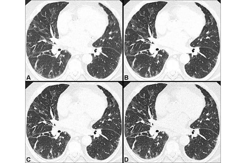 Photon-counting CT shows more post-COVID-19 lung damage