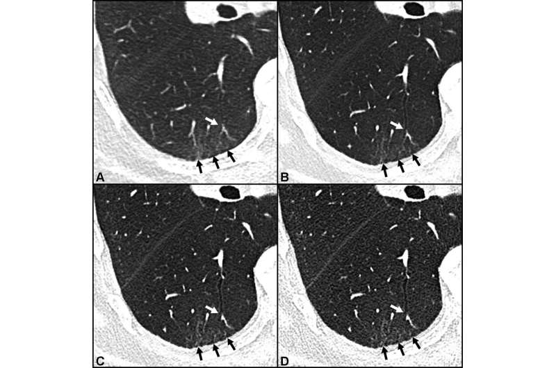 Photon-counting CT shows more post-COVID-19 lung damage