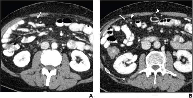 Positive oral CT contrast improves detection of malignant deposits in intraabdominal nonsolid organs