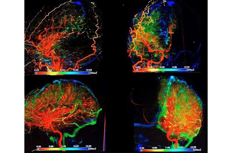 Powerful new ways to attack multiple blood clots deep in the veins of the brain