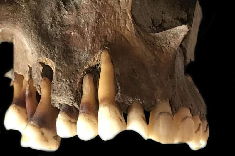 Prehistoric roots of 'cold sore' virus traced through ancient herpes DNA