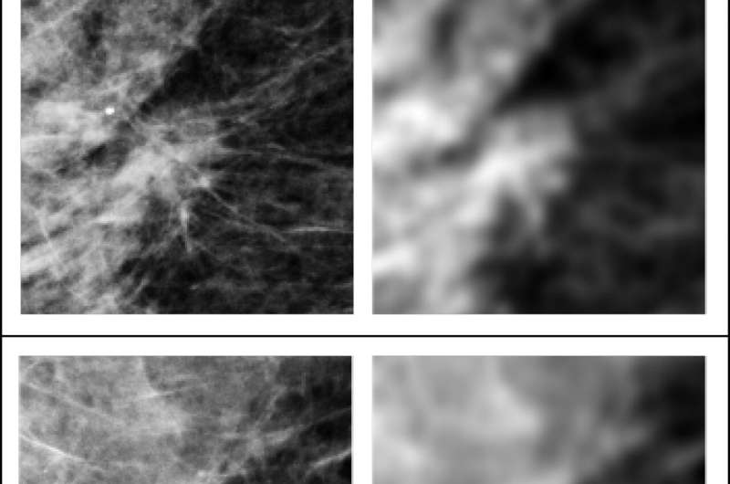 放射科医生，AI系统显示乳腺癌筛查的差异，新案例研究发现
