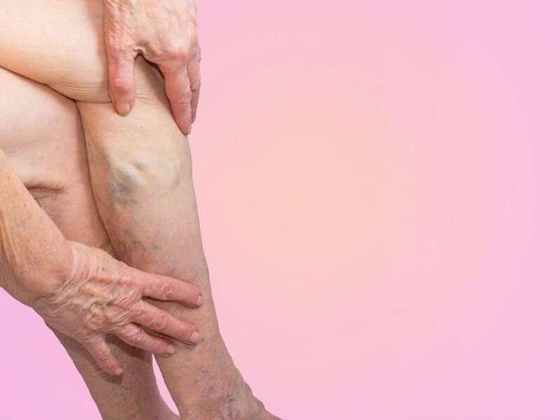 Recommendations developed for lower-extremity varicose veins