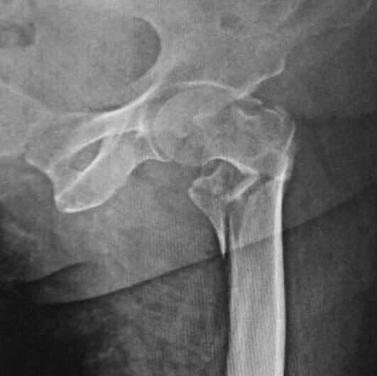 Recovery from a hip fracture varies widely among NHS hospitals, study finds
