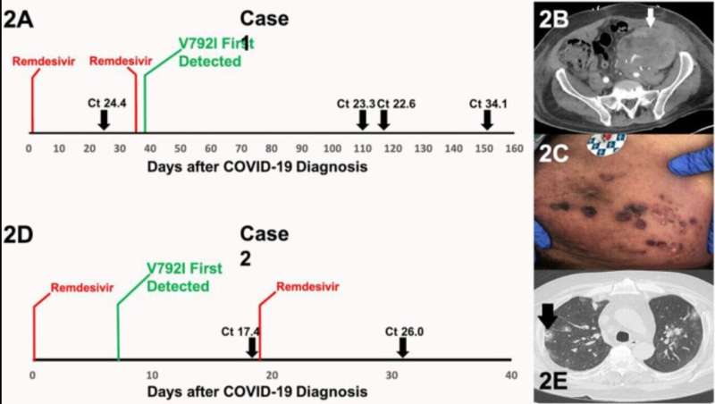Remdesivir-resistant version of COVID-19 detected in organ transplant recipients