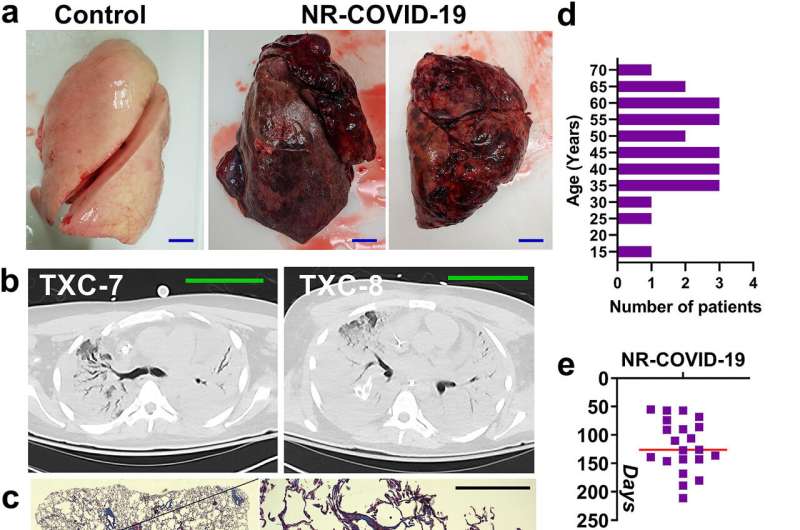 Research reveals how a potentially fatal COVID-19 complication damages lung tissue