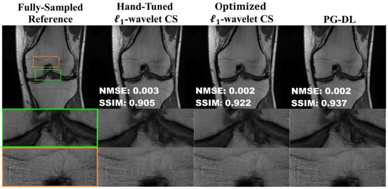 Researchers combine data science and machine learning techniques to improve traditional MRI image reconstruction