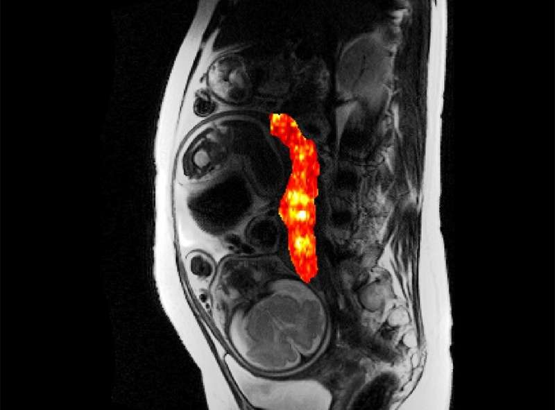 Researchers develop new imaging method to detect complications early in pregnancy