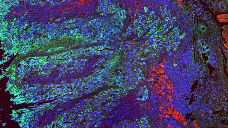 محققان اهداف جدیدی را برای ایمونوتراپی در سرطان روده بزرگ شناسایی کردند