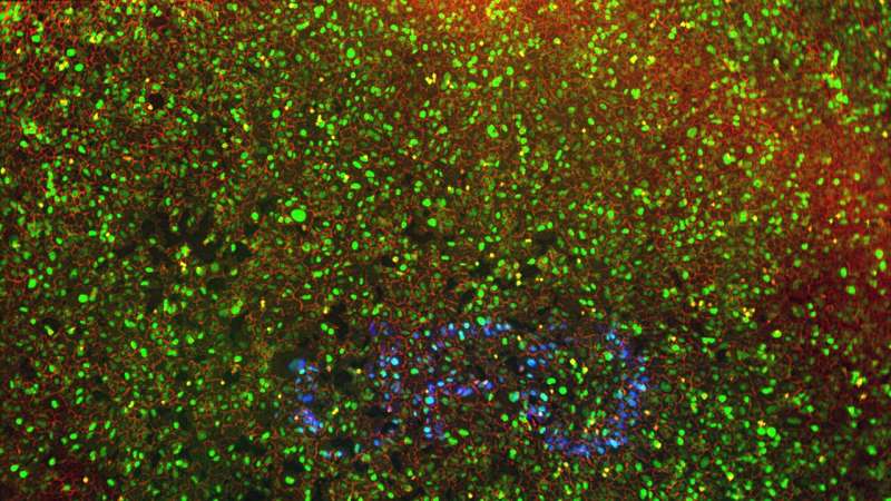 Researchers put a spotlight on aggressive cancer cells