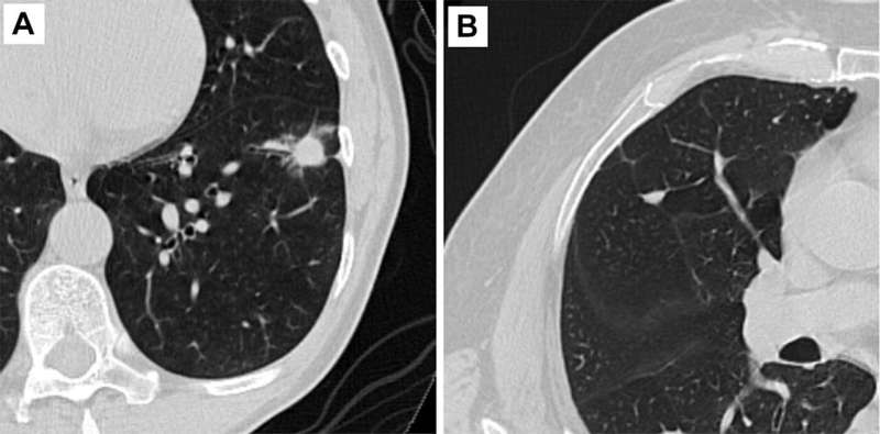 Researchers use AI to predict cancer risk of lung nodules