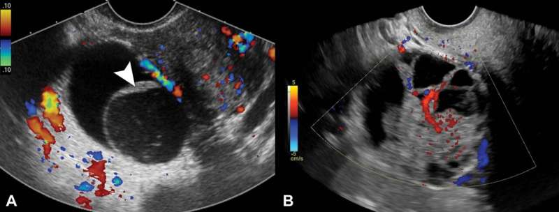 Researchers use ultrasound to predict ovarian cancer