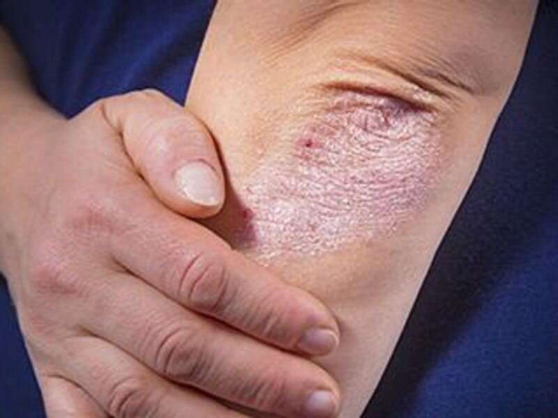 Risk for cancer increased after VTE for patients with psoriasis