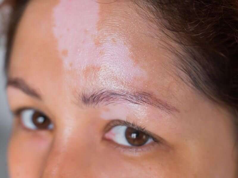 Ruxolitinib creme resulta em maior repigmentação no vitiligo