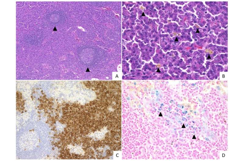 Scientists define independent subtype of idiopathic multicentric Castleman disease