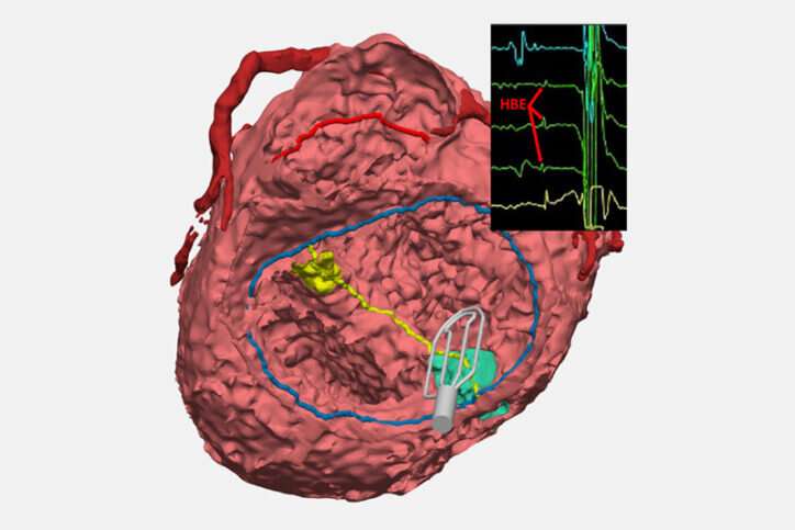 “Seeing” the unseen: A way to pinpoint elusive cardiac conduction tissue