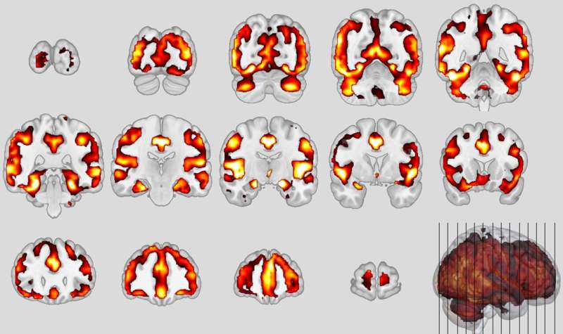 Similarity between schizophrenia and dementia discovered for the first time