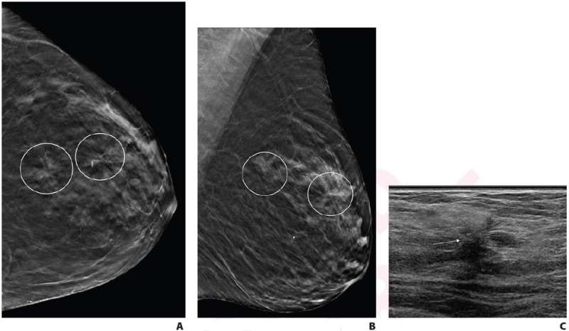 Single vs. multiple architectural distortion on digital breast tomosynthesis