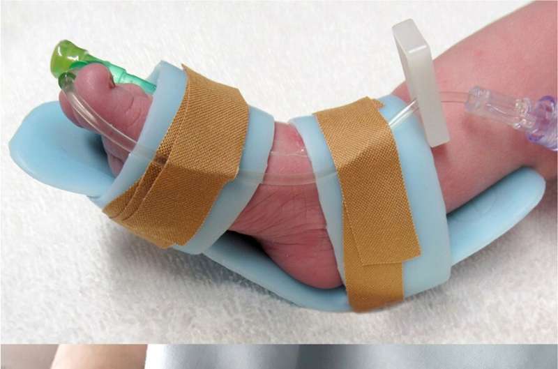 Skin injuries to babies in neonatal care could be avoided with new splint, trial shows