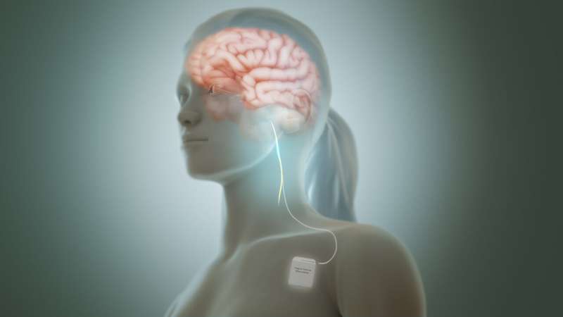 Stimulation of the vagus nerve strengthens the communication between the stomach and the brain