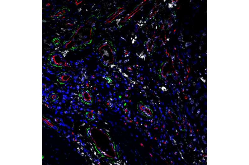 应力蛋白质纤维母细胞可能是一个好的目标未来的癌症药物,宾夕法尼亚大学的研究发现