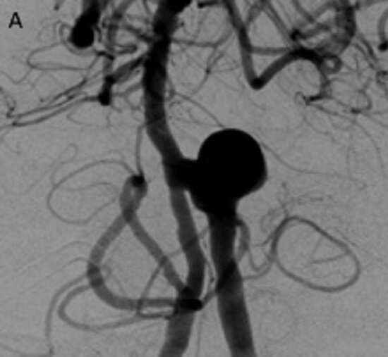 Studies compare best ways to treat wide-neck aneurysms
