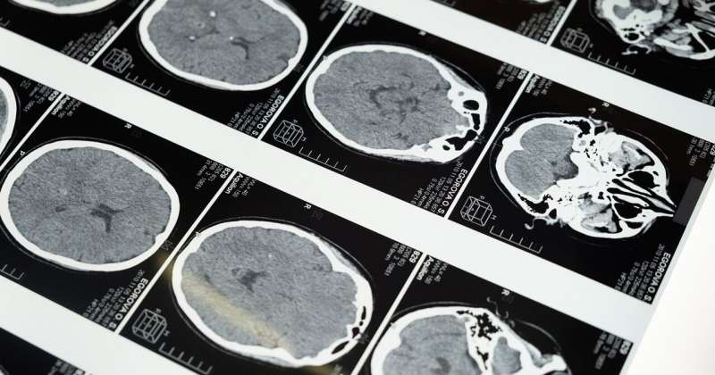 Study looks at brain lesions as early predictors of dementia