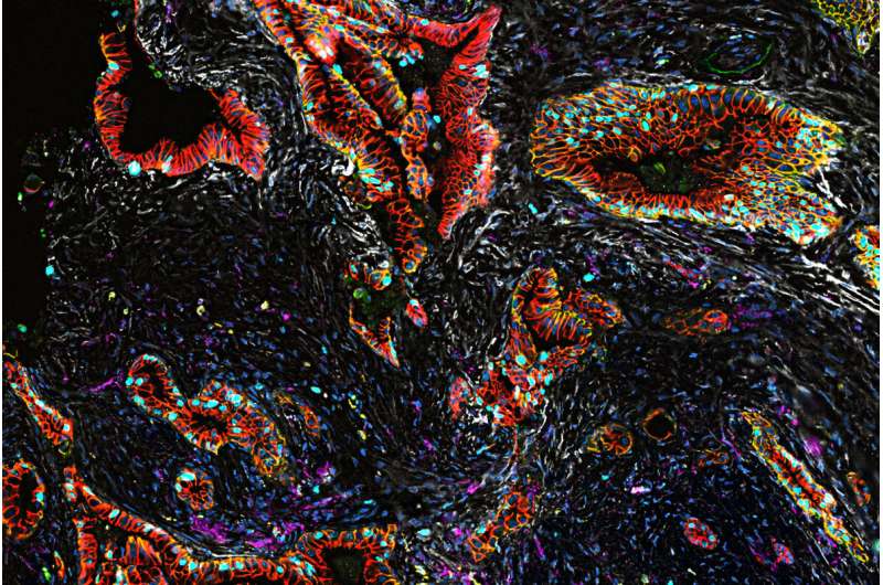 Study offers insights into how pancreatic cancer develops