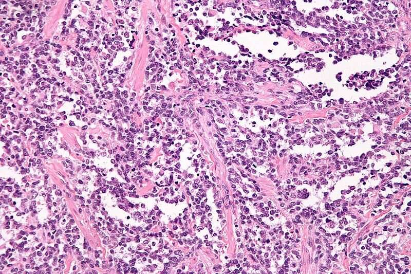 Study reveals new therapeutic target for aggressive type of rhabdomyosarcoma