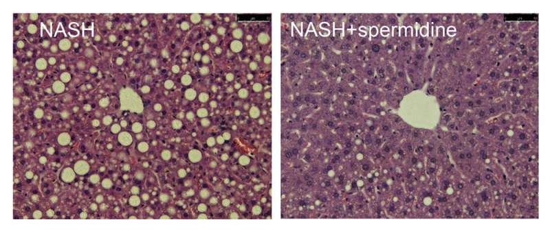 Study suggests spermidine could help to treat advanced non-alcoholic fatty liver disease