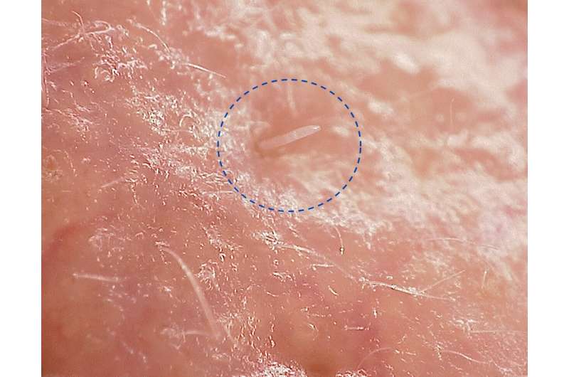 Secretul vieții acarienilor din pielea fețelor noastre