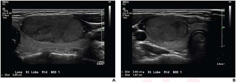 TI-RADS, algorithm guide diagnoses of pediatric thyroid nodules on ultrasound