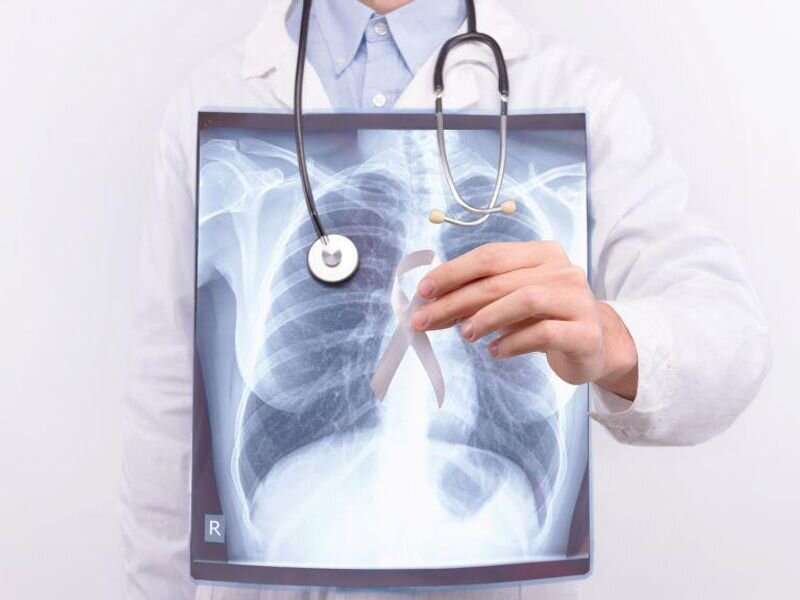 Top medical groups, hospitals urge better access to lung cancer screening