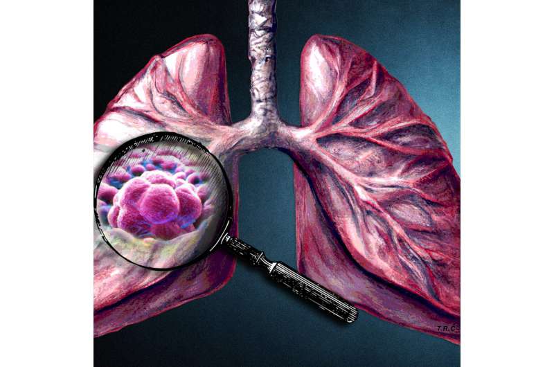 Tumour matrix profiling gives clues to progression of some lung cancers