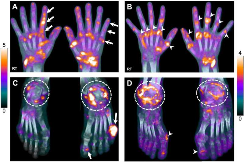 Ultra-low dose total body PET/CT effective for evaluating arthritis