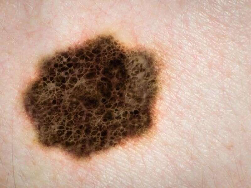 Update shows relatlimab + nivolumab slows advanced melanoma