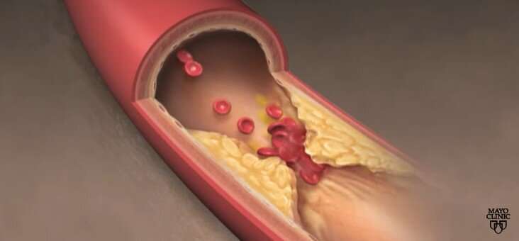 Video: How is peripheral artery disease diagnosed?