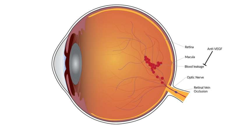 Vision improvement is long-lasting with treatment for blinding blood vessel condition