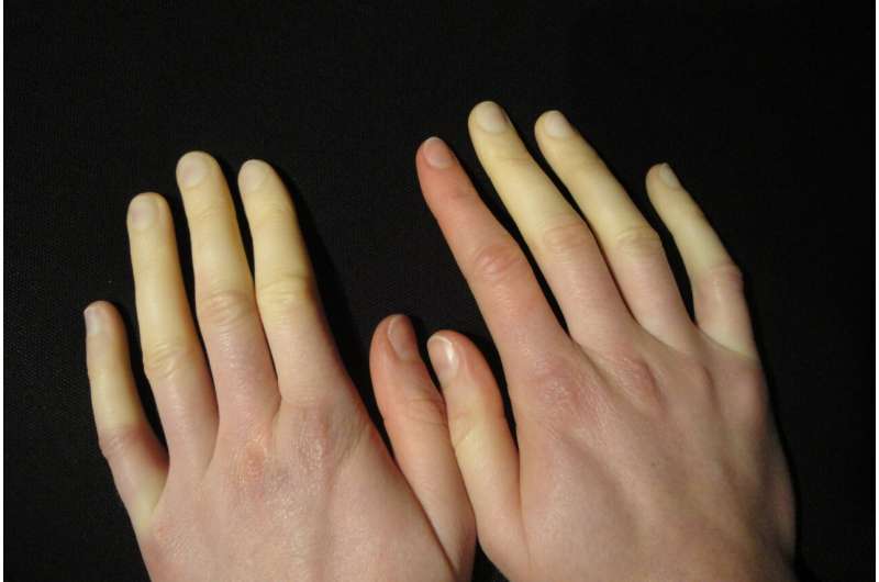 What do you know about Raynaud's disease?