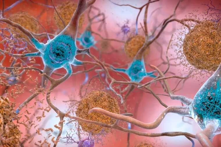 What to know about the new drug trial for Alzheimer's