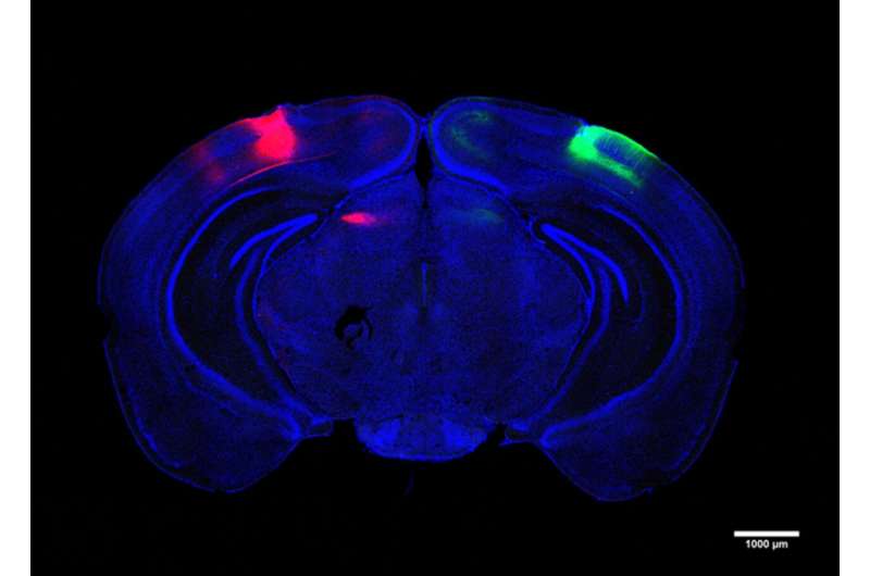 When Alzheimer's degrades cells that cross hemispheres, visual memory suffers