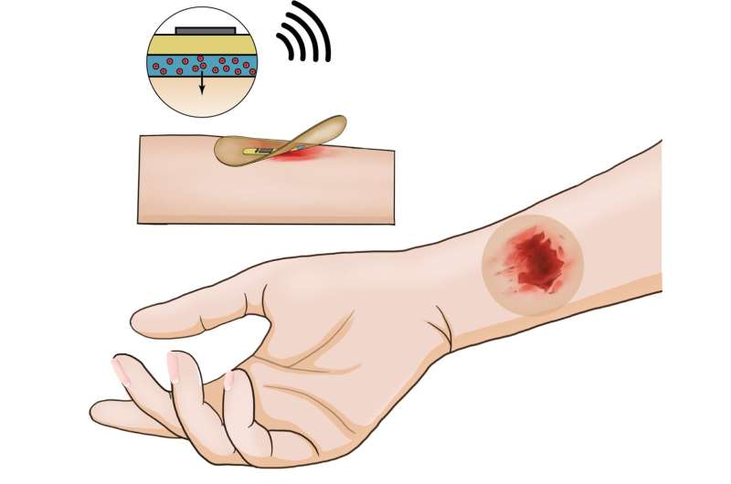 A wireless smart dressing provides new insights into chronic wound healing