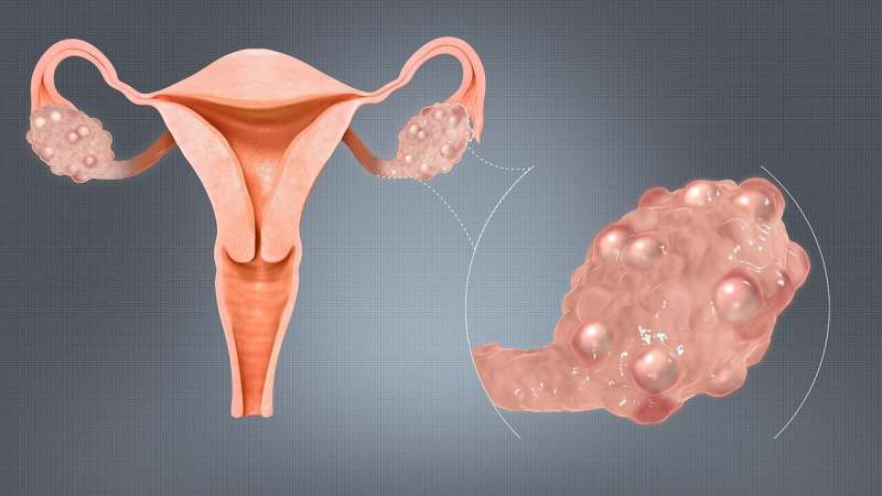 Women may experience different PCOS symptoms depending on where they live