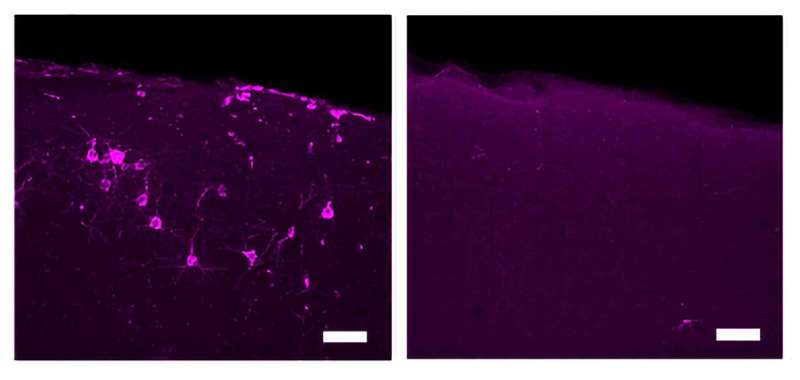 40 Hz vibrations reduce Alzheimer's pathology, symptoms in mouse models