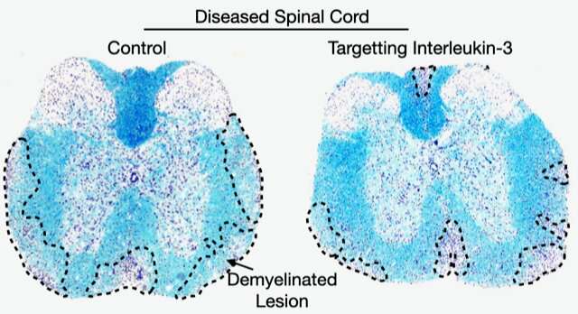 A key biological pathway for multiple sclerosis is uncovered by Mount Sinai researchers