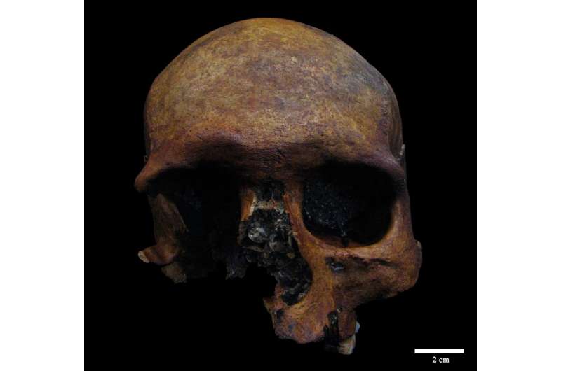 A Roman-period cranial tumor case is detected