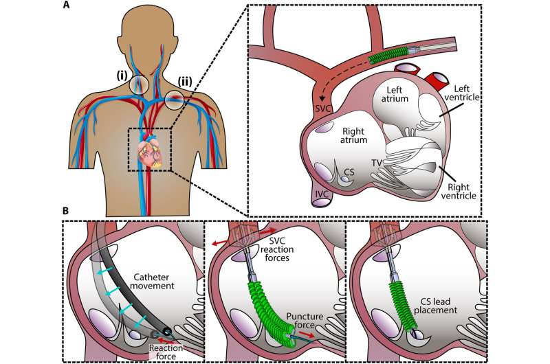 A shape-shifting robotic catheter could make heart surgery safer