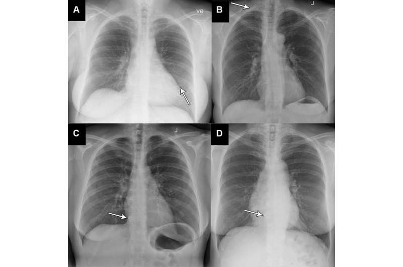 AI accurately identifies normal and abnormal chest x-rays