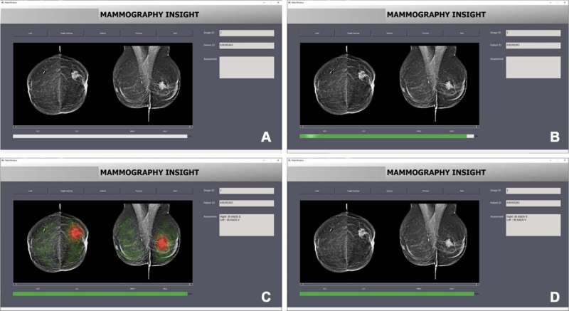 AI bias may impair radiologist accuracy on mammogram